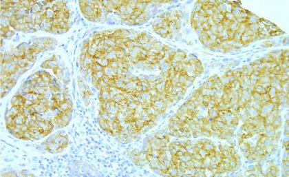 Areas containing RAB27A molecules (brown staining) within a section of a melanoma. Areas containing RAB27A molecules (brown staining) within a section of a melanoma.